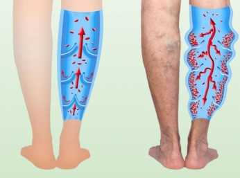 SUY GIÃN TĨNH MẠCH: NGUYÊN NHÂN, TRIỆU CHỨNG & CÁCH PHÒNG BỆNH