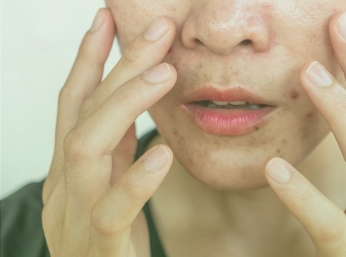 BỤI MỊN - THỦ PHẠM GÂY MỤN VIÊM TRÊN DA