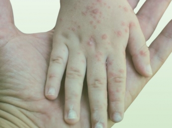 CÁCH PHÂN BIỆT SỞI VÀ RUBELLA & CÁC BIỆN PHÁP PHÒNG NGỪA HIỆU QUẢ